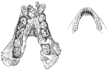 Comparison between the jaws of Gigantopithecus and human